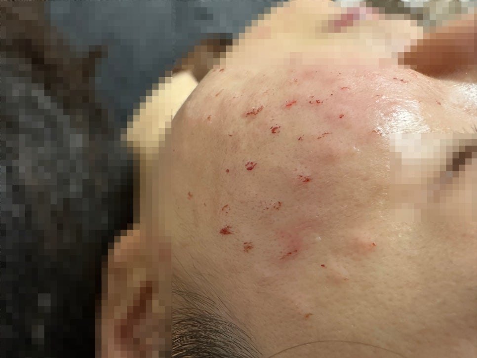 Embossing bumps immediately after a Rejuran Healer session (patient photo, face anonymized)